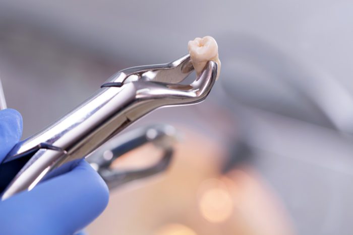 Tooth Extraction in Dundalk, Maryland
