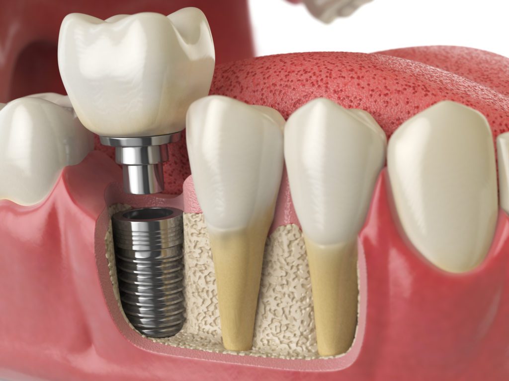 Tooth Implants in Dundalk, Maryland